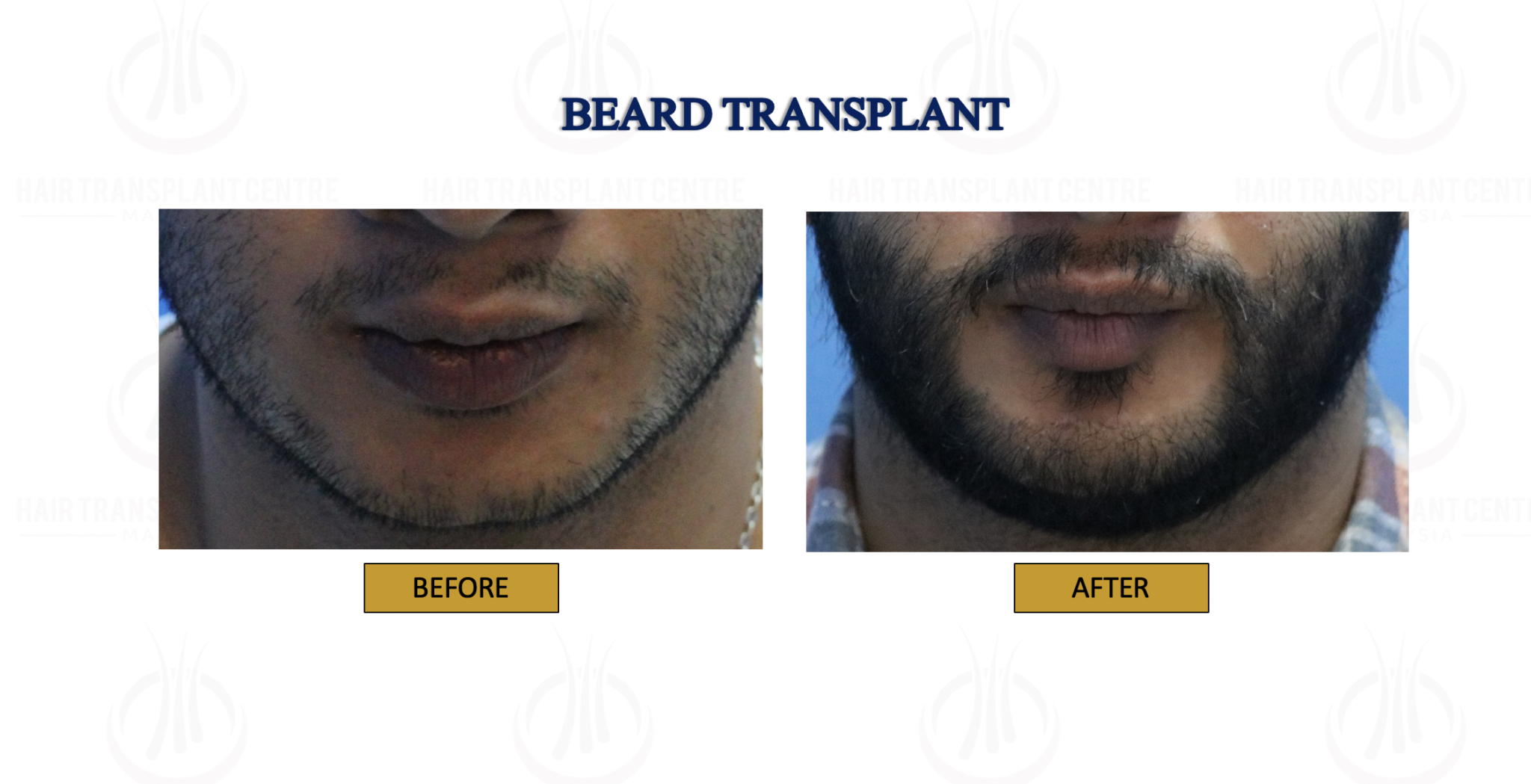 Beard Transplant 2 Klinik Dr Inder