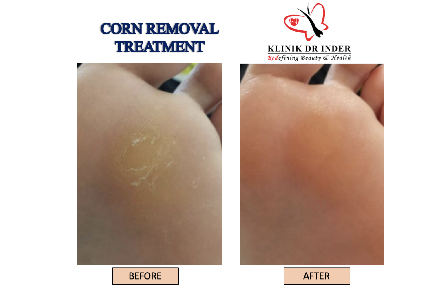 corn-removal-laser-treatment-aesthetic-clinic-klinik-dr-inder