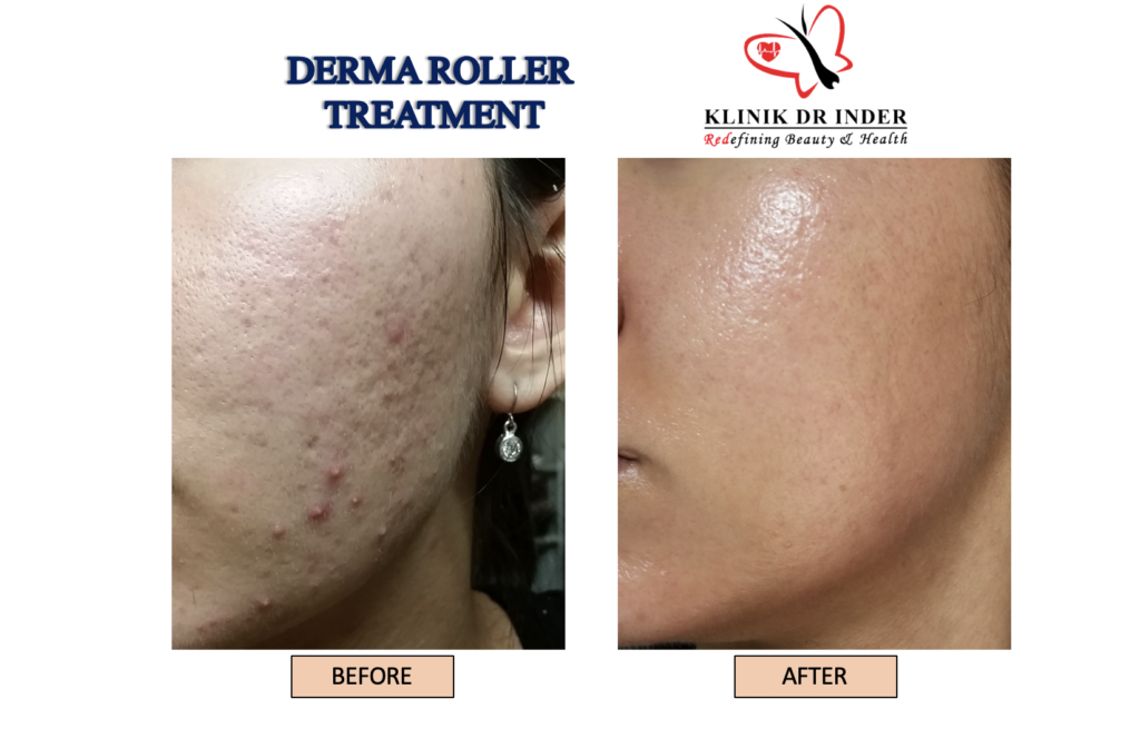 Before And After Treatment for Derma Roller