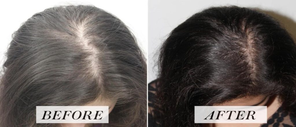 Hair PRP - Rapid Hair Growth - Hair Loss Treatment