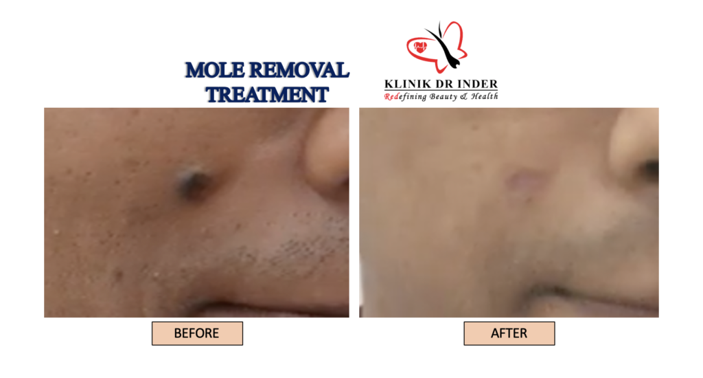 Before after result for mole removal