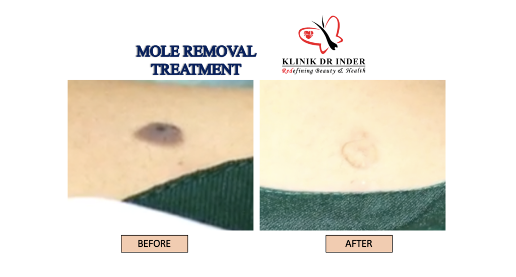 Mole Removal Result Treatment