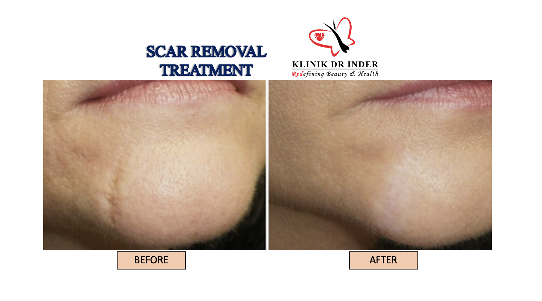 SCAR REMOVAL BEFORE AFTER 3 