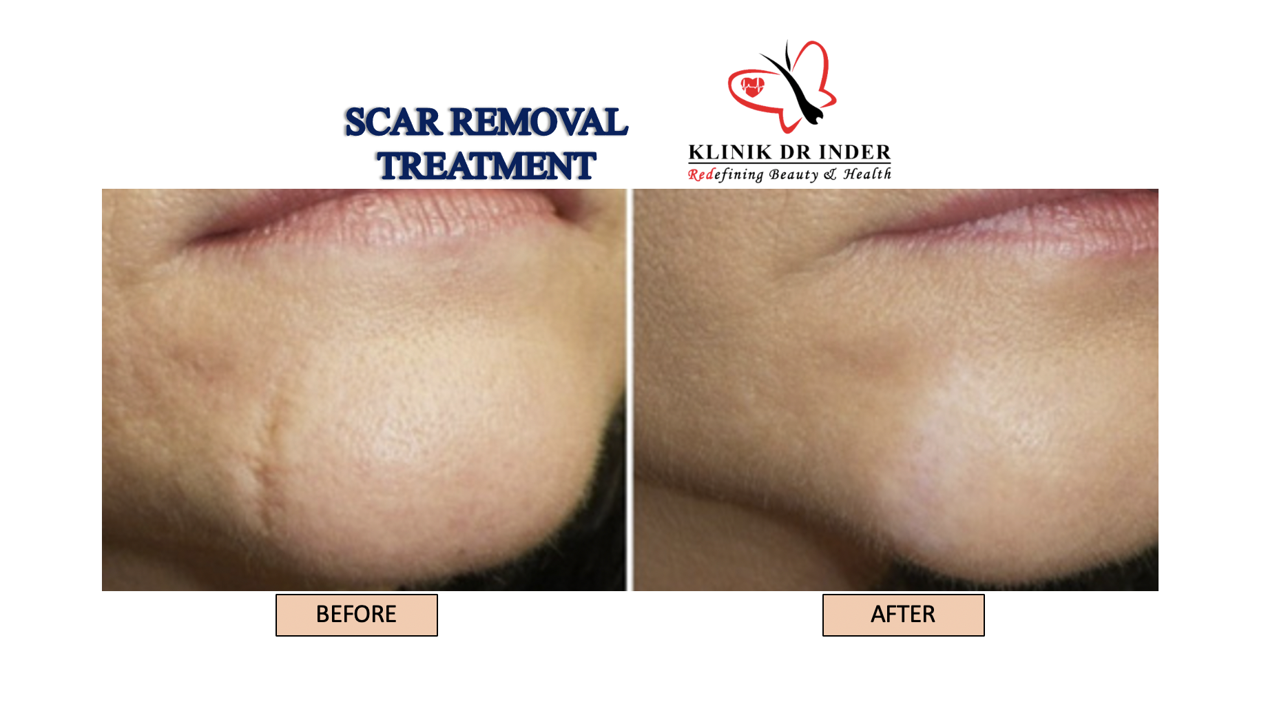 Laser Scar Removal Scar Removal Treatment Aesthetic Clinic