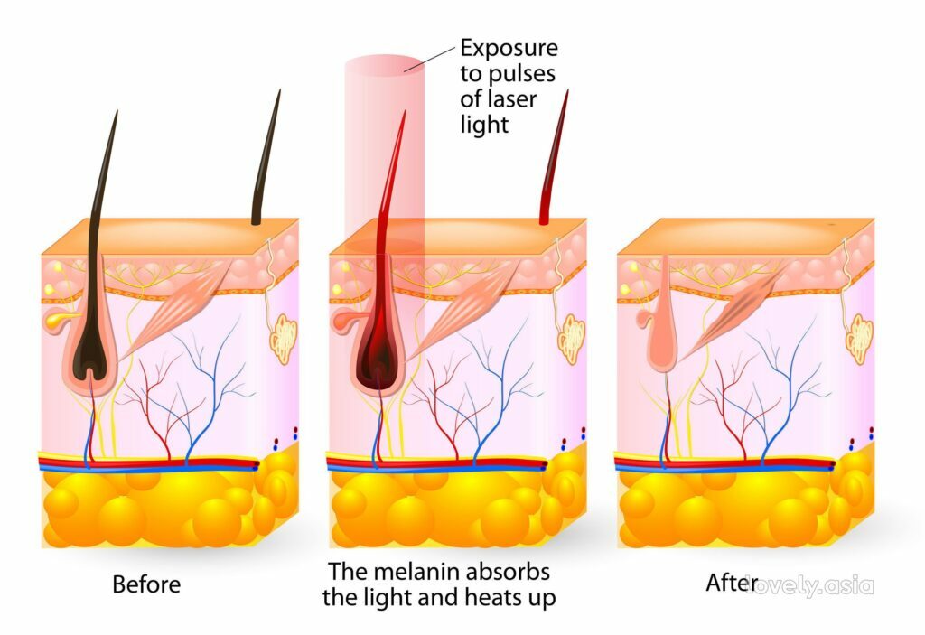 Laser Hair Removal Graphical Explanation