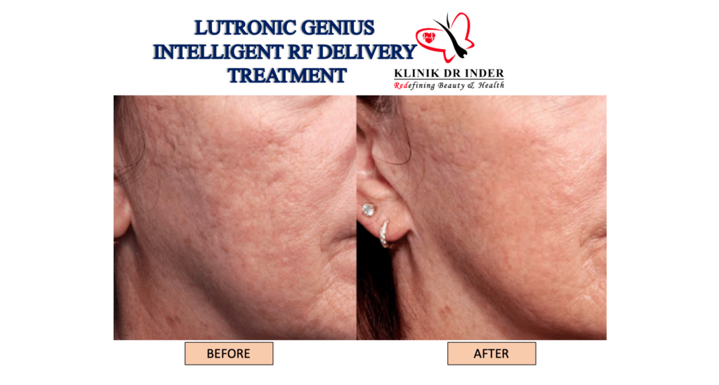 lutronic genius intelligent micro needling before after