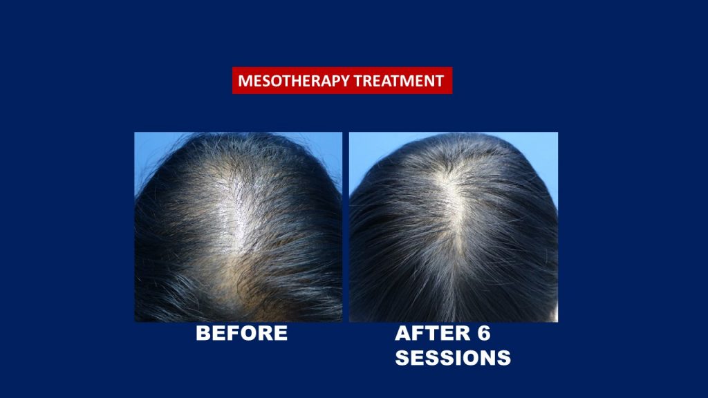 mesotherapy before after.jpg