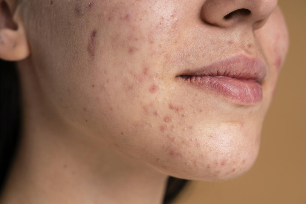 confident young woman with acne close up.jpg