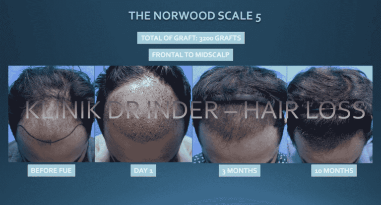 Fue Crown Hair Transplant