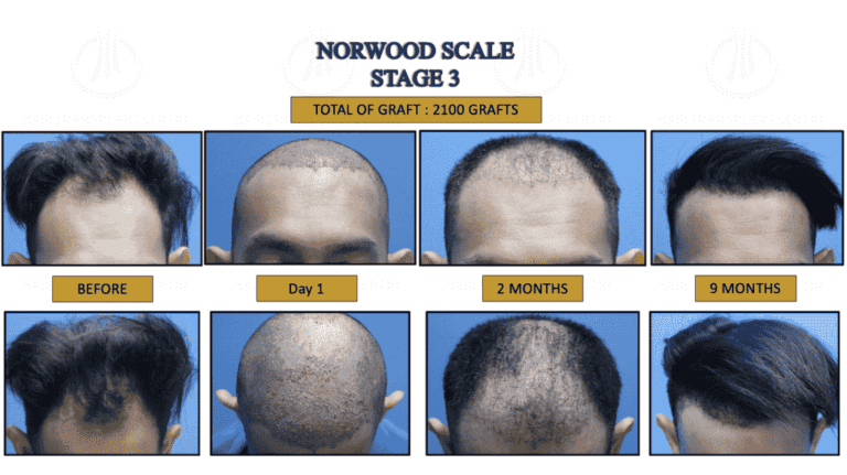 Fue Hair Transplant