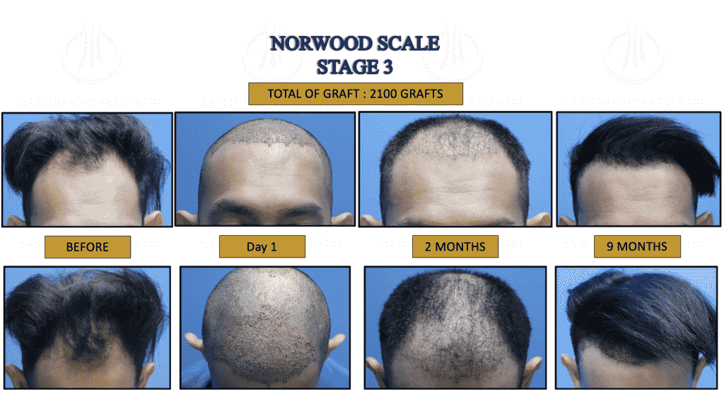 Fue Hair Transplant