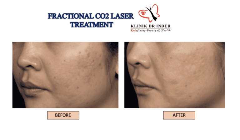 CO2 Laser Resurfacing