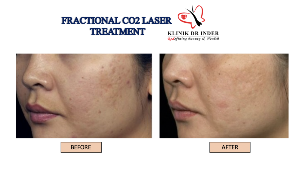 skin resurfacing, fractional laser