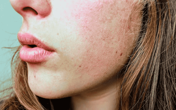 Rosacea Treatment