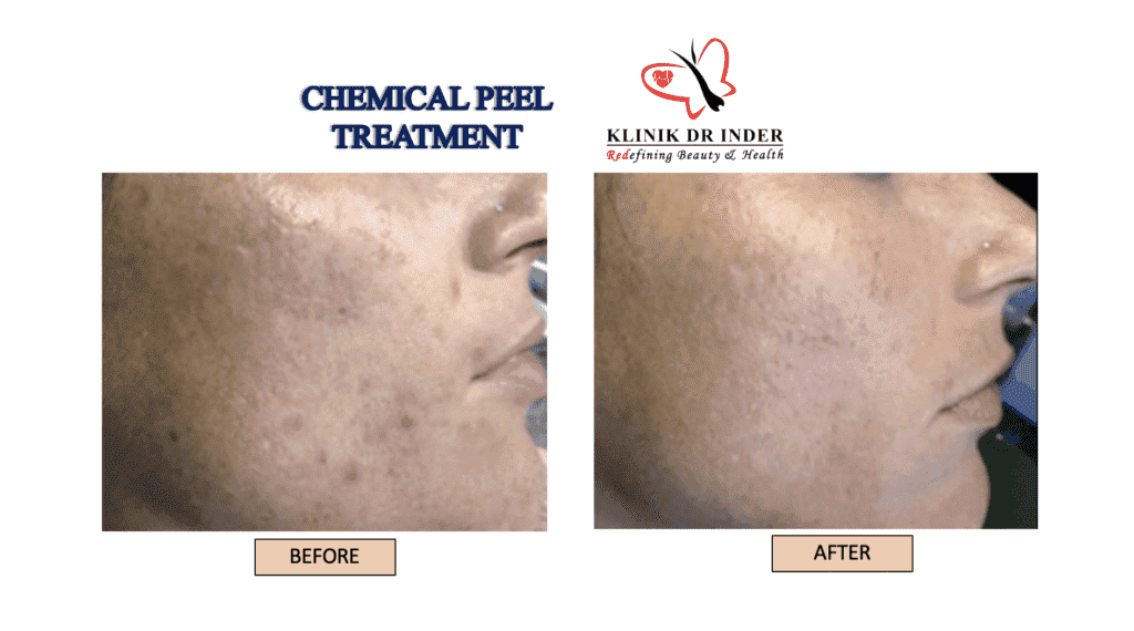 Professional Chemical Peel