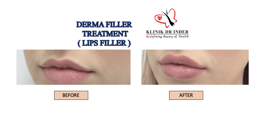 How Long Lip Fillers Last