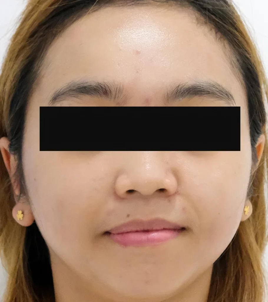 Chemical Peel After 2.1