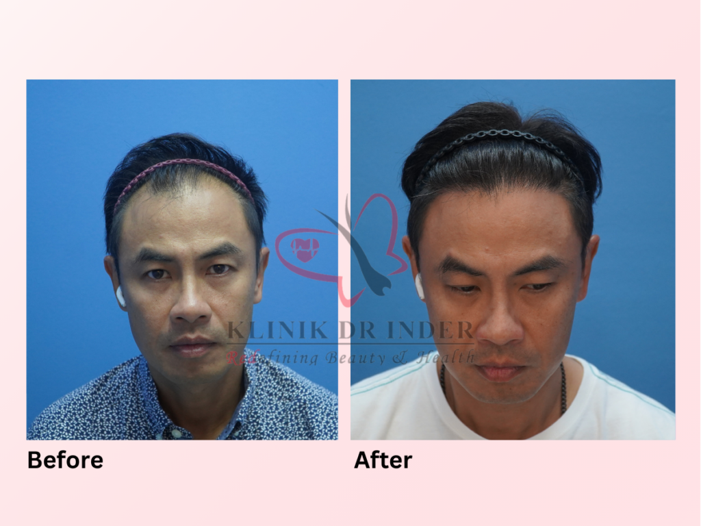 Klinik Dr Inder - Hair Transplant Procedure - Final Resulat