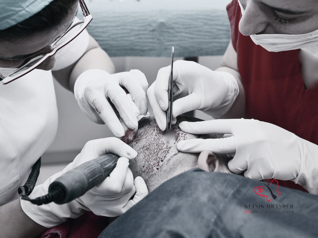 Klinik Dr Inder - Hair Transplant Procedure - Harvesting Hair Follicles