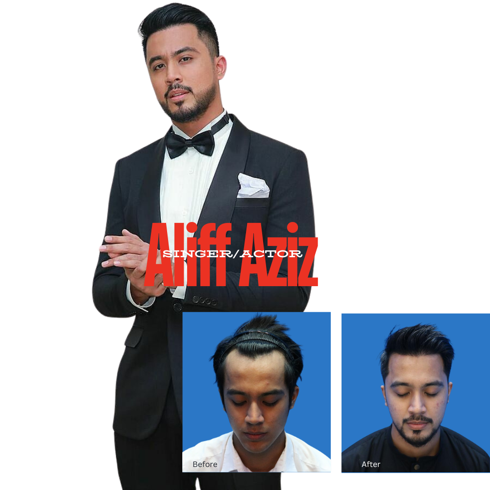 hair transplant centre malaysia aliff aziz