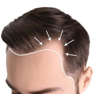 Corrective Hair Transplant for Male