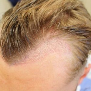 Corrective Hair Transplant 4