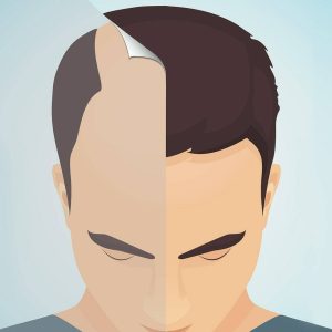 Transgender Hair Transplant 3